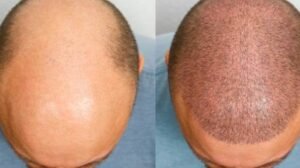 Hair Transplant