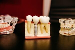 most affordable dental implants