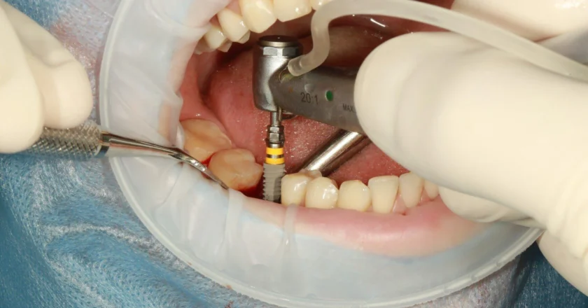 How Full Mouth Dental Implants Transformed Their Smiles and Lives