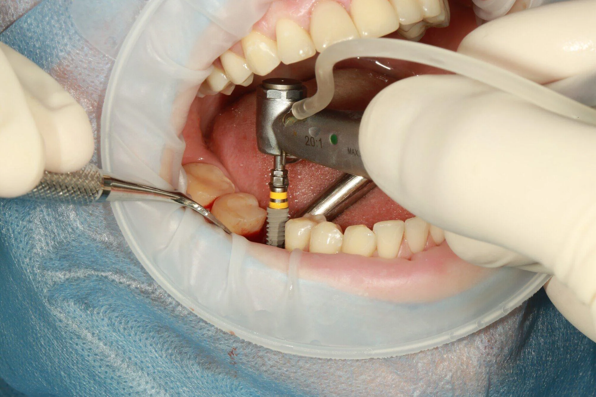 full mouth dental implants